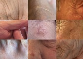 cicatrices-1